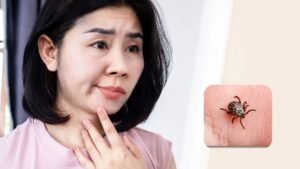 woman examining a tick bite on her chin